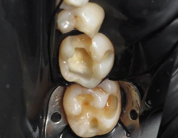 Реставрация жевательных зубов в стиле "Black style"