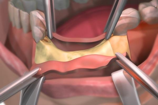 Применение ксеногенного коллагенового материала «Коллост» в хирургической стоматологии и челюстно-лицевой хирургии для устранения дефектов челюстей различной этиологии