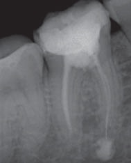 При лечении зуба остался инструмент в зубе