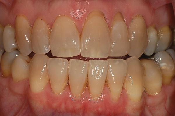 Отбеливание тетрациклиновых дисколораций зубов