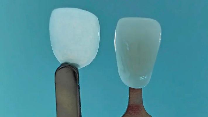 UltraThineer - самый тонкий в мире зубной винир