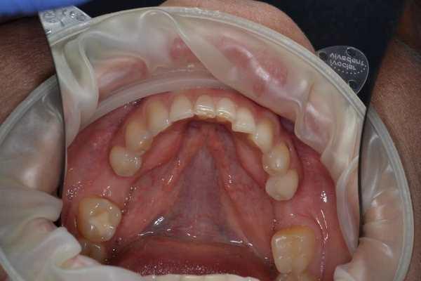 Имплантация 36 и 46 зуба + СДТ + ФДМ в 1 визит