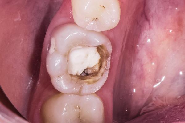 Клинический случай постэндодонтической реабилитации жевательного зуба методом непрямой композитной реставрации