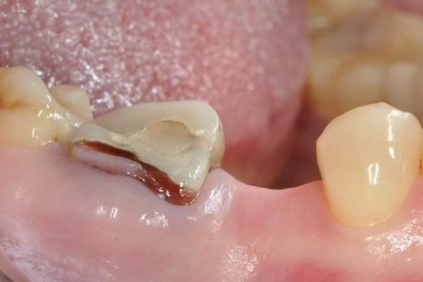 Клинический случай одномоментной и отсроченной имплантации в жевательном отделе нижней челюсти