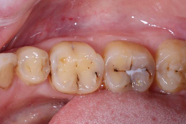 Доступ к проксимальной поверхности зуба