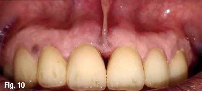 Болит место укола после лечения зуба. Нормально ли это?