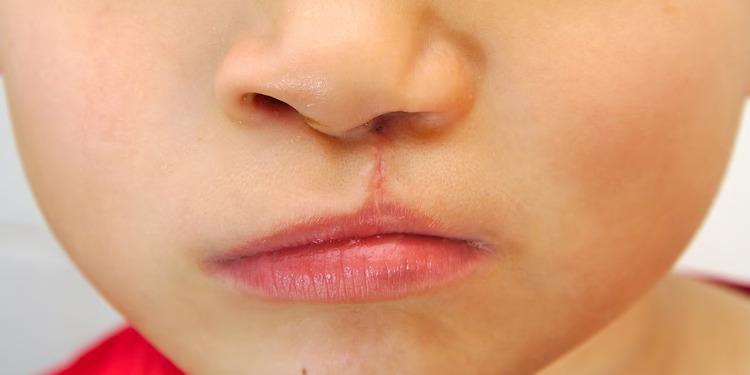 Исследование показало, что заячья губа вызвана генами и окружающей средой