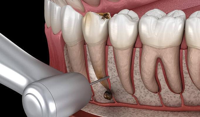 Ампутация/резекция корня: эффективное средство для сохранения многокорневого зуба