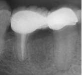 Вертикальный перелом корня зуба