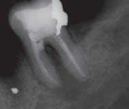 Лечение зубов сломался инструмент в канале зуба