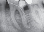Лечение зубов сломался инструмент в канале зуба