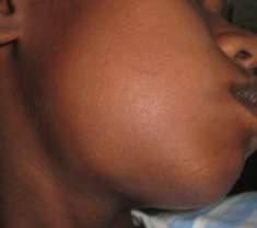 Плексиформная амелобластома у 14 летнего ребенка