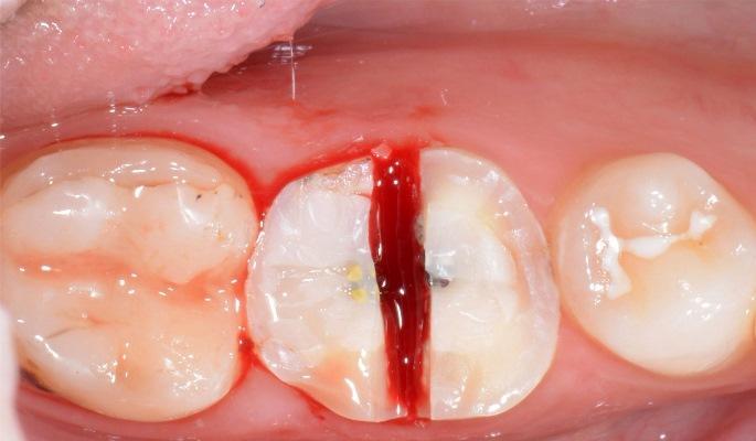 Замена многострадального зуба на имплантат