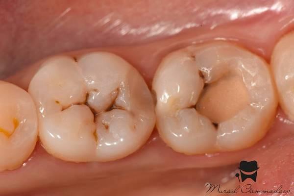 Лечение вторичного кариеса и прямая реставрация 3.6, 3.7 зубов