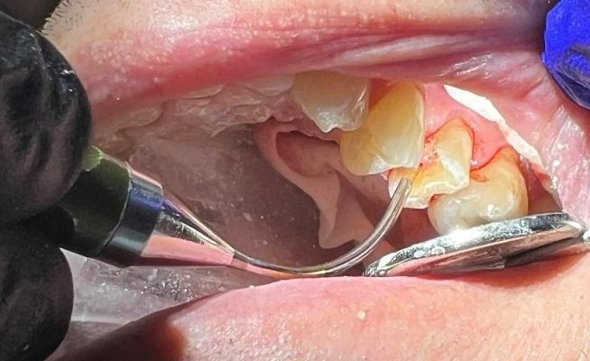 Лазерное лечение пульпы потенциально позволяет избежать эндодонтического лечения