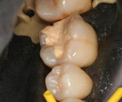 Секреты лечения кариеса и реставрации зубов