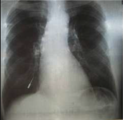 Дыхательная недостаточность, развившаяся вследствие аспирации спредера (уплотнителя гуттаперчи): клинический случай и практическое руководство