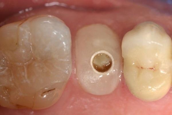Установка имплантатов в лунки удаленных зубов с вестибулярными дегисценциями