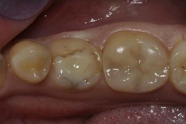 Нормализация окклюзии при анкилозе молочного зуба композитной реставрацией