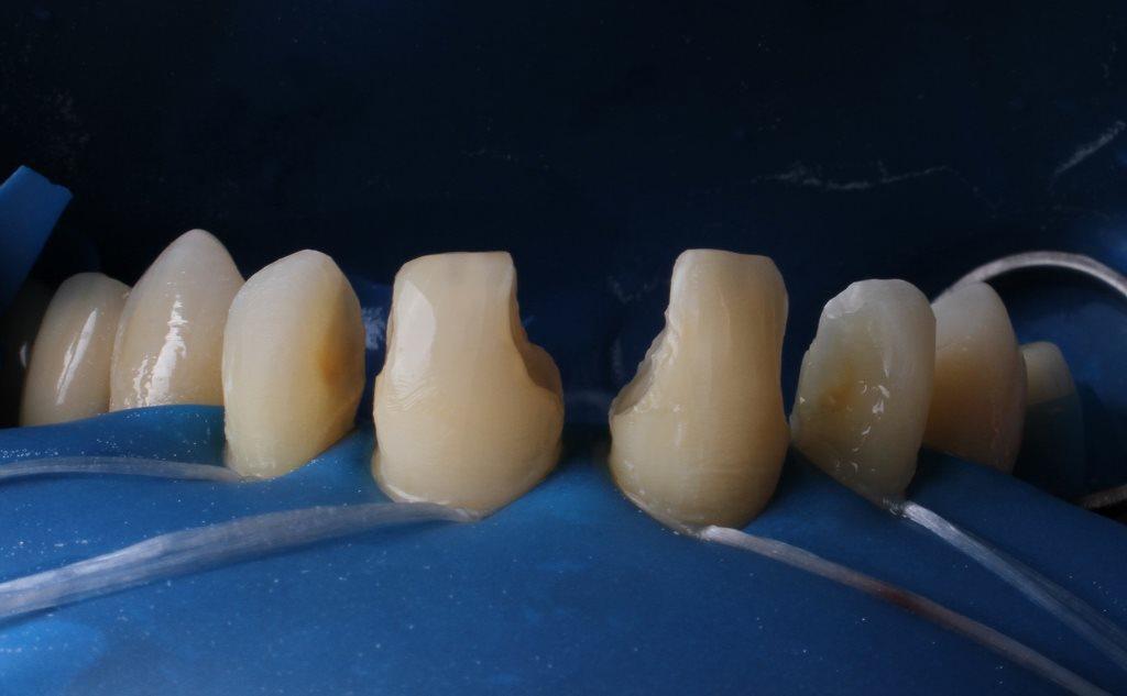 Цена композитной реставрации. Бюгель фронтальные зубы. Реставрация зубов композитным материалом. Реставрация зуба композитным материалом. Композитная реставрация зубов.