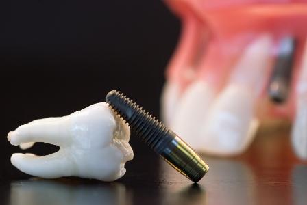 Согласно исследованию, у пациентов не всегда правильное представление о зубных имплантатах