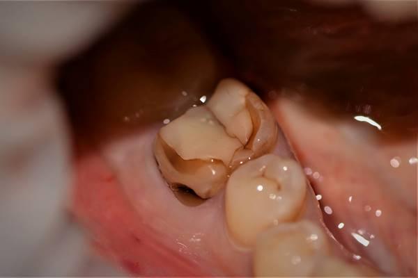 Компромиссный случай удаления зубов 3.6 и 4.6 с одномоментной и отсроченной имплантацией