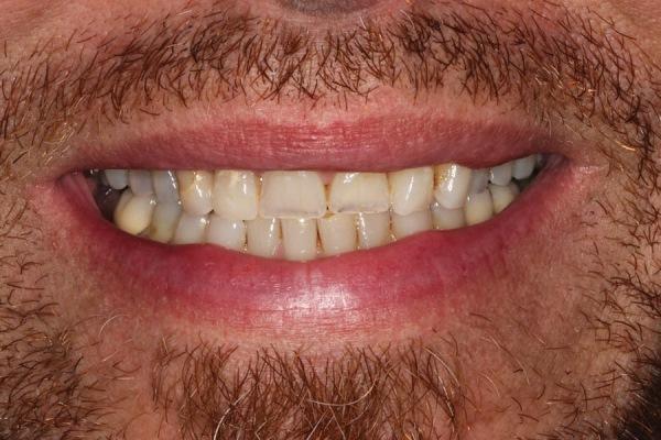 Реконструкция одной дуги для коррекции ограниченного жевательного паттерна с использованием цифровых и аналоговых методов