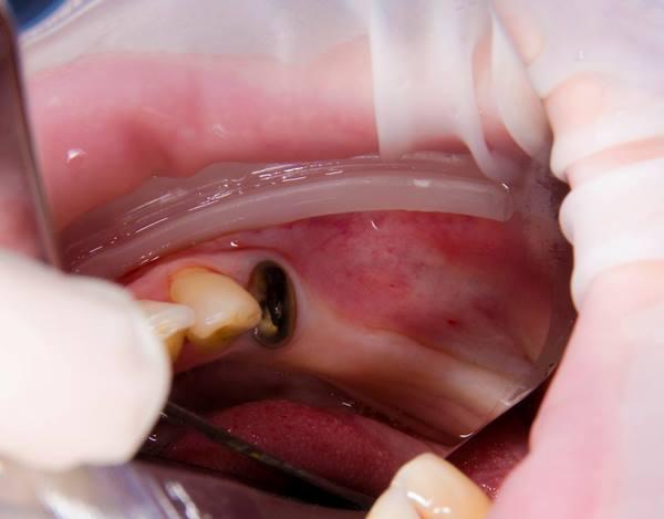 Случай направленной костной регенерации дистального отдела нижней челюсти методикой "Sausage Technique"