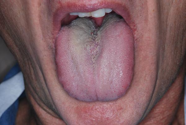 Причины сухости во рту (ксеростомии)