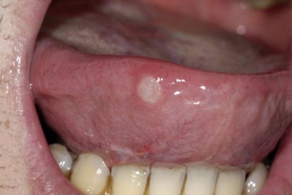 Афтозный стоматит на языке может быть ранним симптомом коронавируса