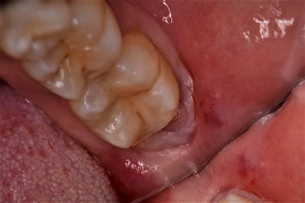 Удаление зуба 3.8 с транспозицией нижне-альвеолярного нерва