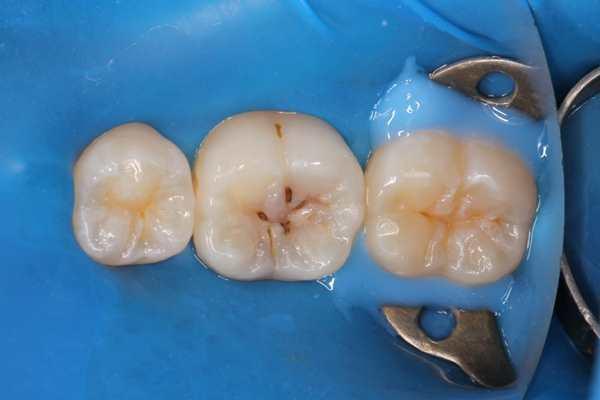 Реставрация жевательного зуба по шаблону