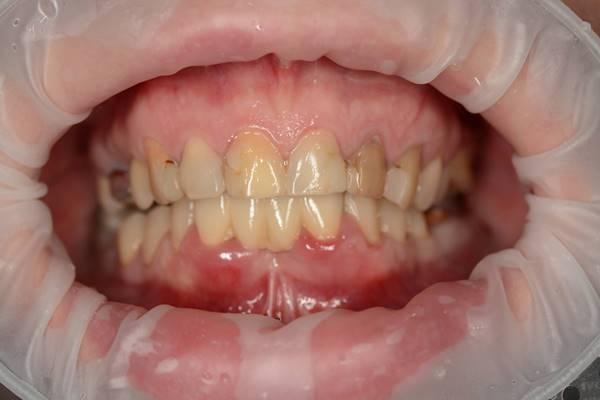 Одномоментная имплантация в проекции 3.2 и 4.2 зуба с костной пластикой в проекции 3.2 - 4.2