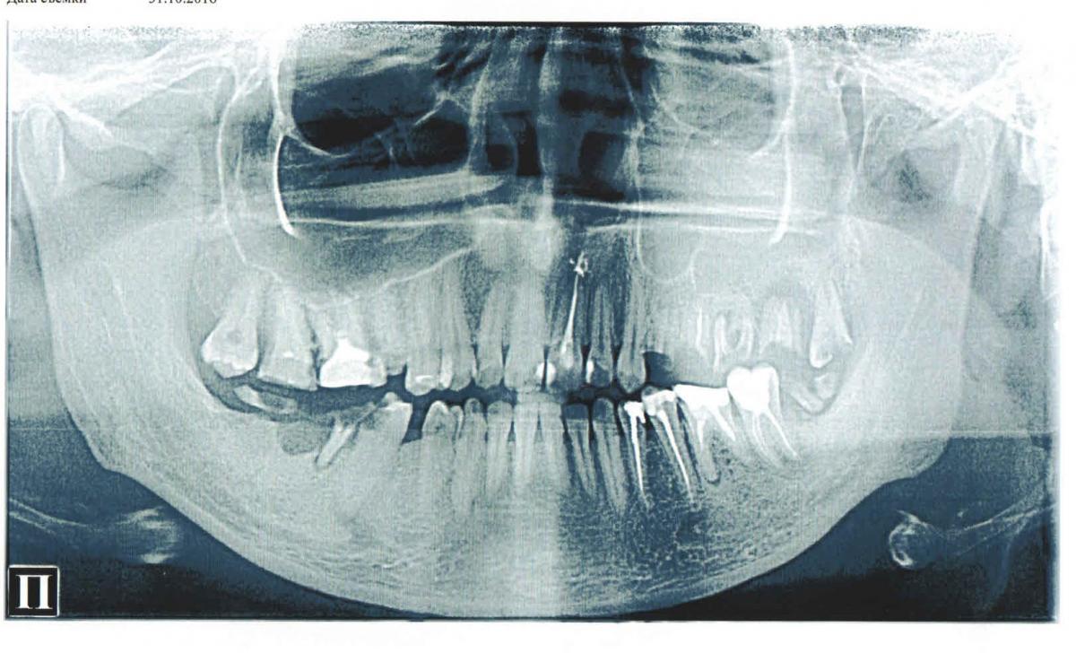 Немеет лицо после лечения зуба