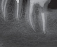 Инструмент при лечении зуба сломался