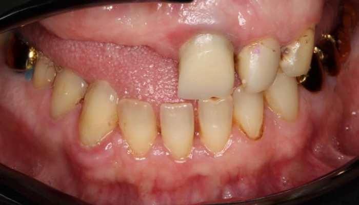 Эстетико-функциональная реабилитация пациента с частичной потерей зубов