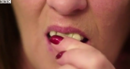 Жительница Англии приклеивала выпавшие зубы на суперклей в течение 10 лет