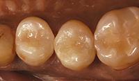 Матрица при лечении зубов фото