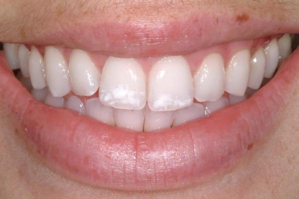 Эволюция виниров: баланс между эстетикой, функцией и консервативностью