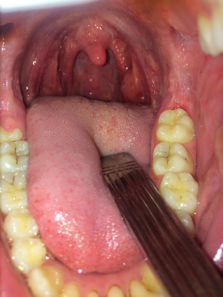 Почему возникает сухость во рту после антибиотиков?