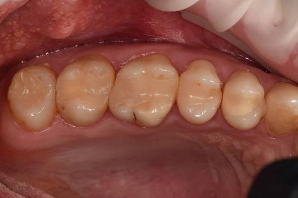 Реабилитация жевательной группы зубов