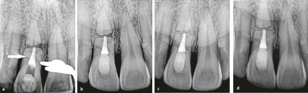 Рентгеновские снимки перелома корней зуба