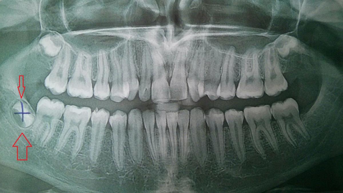 Зуб 8 корень. Ретинированный зуб мудрости рентген. Ретинированный дистопированный зуб.