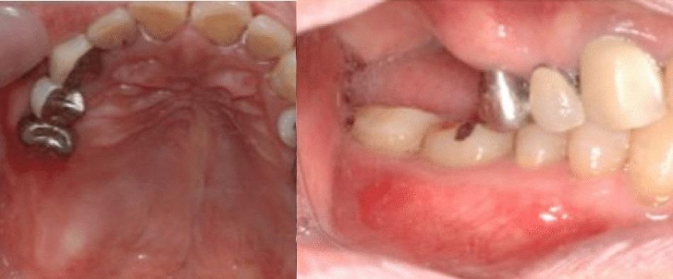 Сэндвич-техника при аугментации заднего отдела верхней челюсти: клинический случай в 9-летней ретроспективе