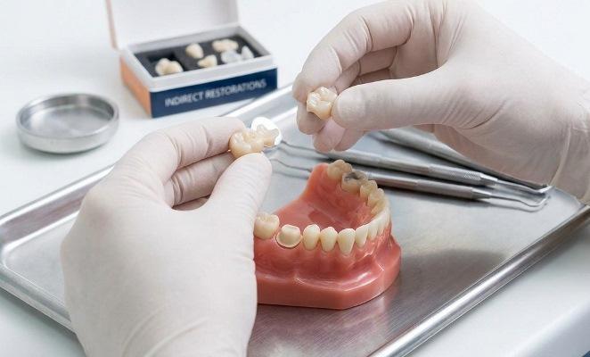 Современные непрямые реставрации: обзор субтрактивных и аддитивных материалов и технологий