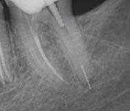 При лечении зуба остался инструмент