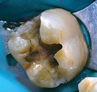 Лечение зуба без прокладки