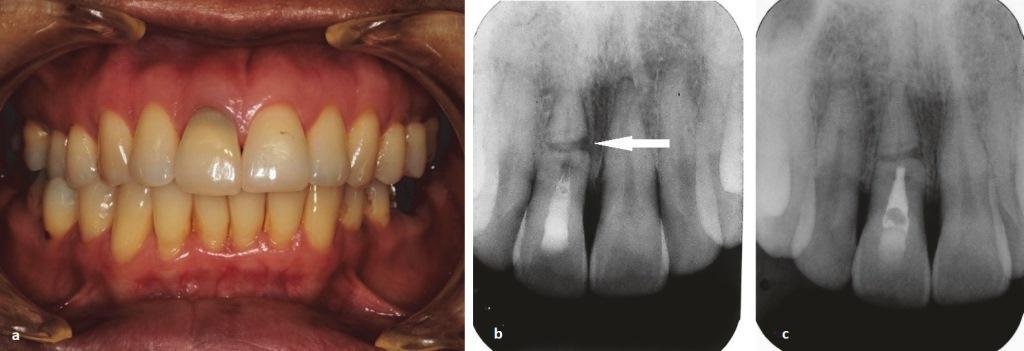 Рентгеновские снимки перелома корней зуба