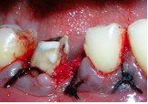 Вертикальный перелом зуба