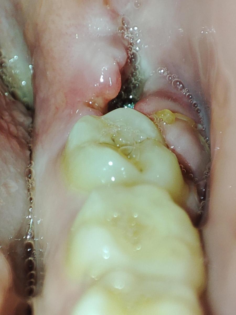 Сухая лунка: симптомы и лечение альвеолита после удаления зуба — ROOTT